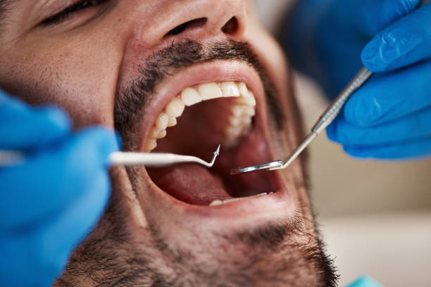 Best Emergency Dental Extractions in Franklin, LA